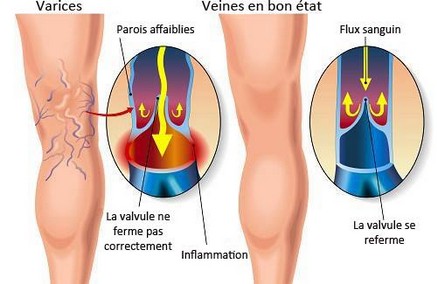 Schéma explicatif des varices, Docteur Christine D'Hont, chirurgien vasculaire, Charleroi Belgique