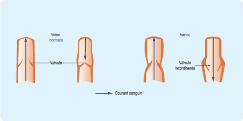 Schéma expliquant le rôle des valvules dans les veines, Dr Christine D'Hont, Phlébologue, Charleroi Belgique